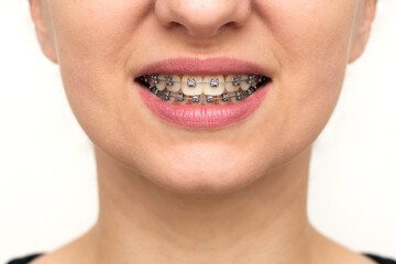 Fototapeta premium Closeup of woman with braces on teeth. Smiling face with braces isolated on white background. Orthodontic treatment concept. Closeup of healthy female mouth with metal braces.