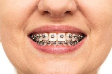Closeup of woman with braces on teeth. Smiling face with braces isolated on white background....