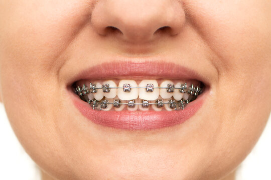 Closeup of woman with braces on teeth. Smiling face with braces isolated on white background. Orthodontic treatment concept. Closeup of healthy female mouth with metal braces.