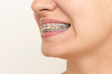 Closeup of woman with braces on teeth with elastics. Smiling face with braces isolated on white...