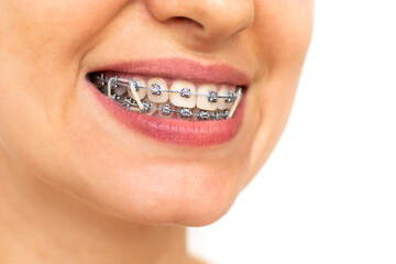 Closeup of woman with braces on teeth with elastics. Smiling face with braces isolated on white background. Orthodontic treatment. Closeup of healthy female mouth with metal braces. 
