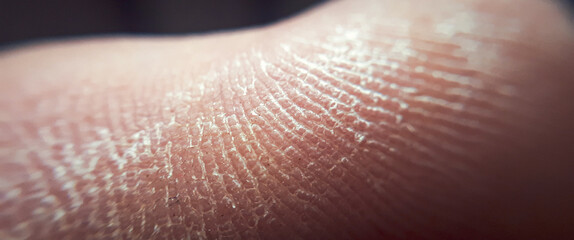 Diabetic foot. Skin with sebaceous secretions on the human heel close up. Human skin problems. Dry...