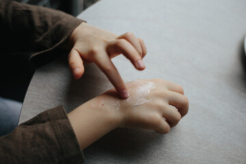 A small child smears redness on the hand with baby cream. The concept of treatment and skin care with cream, frostbite and peeling skin. Allergy problem