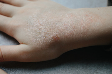 children hand with atopic dermatitis. eczema on hand. psoriasis on kids hands
