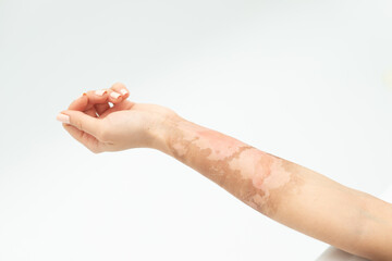 Skin burn on a female hand on a white background
