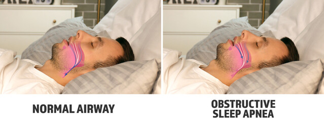 Illustrations showing difference between normal breathing and obstructive sleep apnea