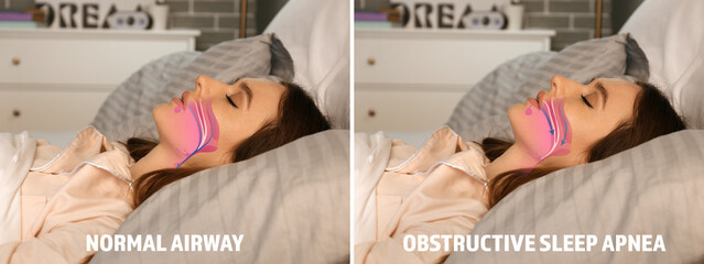 Illustrations showing difference between normal breathing and obstructive sleep apnea