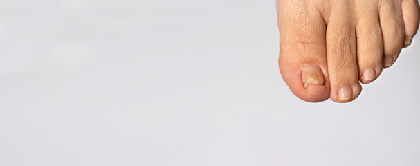 Ingrown toenail from wearing tight shoes. Nail fungus macro photo, onychomycosis, dermatomycosis,...