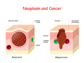 Cancer and Neoplasm. comparison and difference between Malignant and Benign tumor