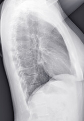 Woman chest x-ray. Lateral view.