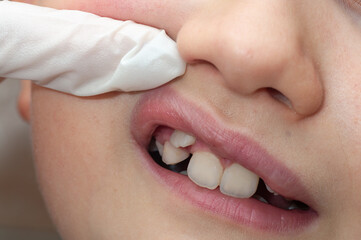 Orthodontist examining boy mouth. The tooth is growing in the wrong place.