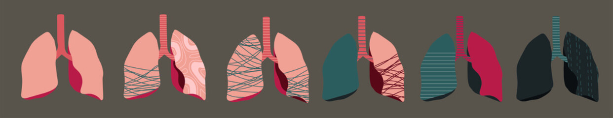 vector set of human's lungs, stages of cancer