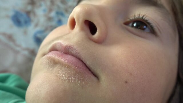 Fethiye, Turkey - 4th of November 2020: 4K Face of seven years old child with skin affected by atopic disease 
