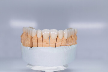 Ceramic tooth crown on plaster model. Finished new ceramic bridge on plaster model, frontal view....