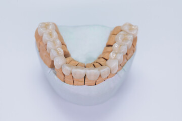 Ceramic tooth crown on plaster model. Finished new ceramic bridge veneers on plaster model. Dental veneers are lying on a wite background in the laboratory