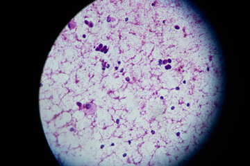 Microscopic view of Papillary carcinoma of the Lung.