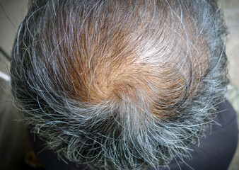 Gray hair / bald man,close-up.Hair loss, hair fall everyday serious problem, on white background.Solutions for hair loss.	
