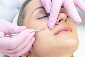 Procedure for cleaning the skin of the face with a steel appliance with a spoon from blackheads and acne.