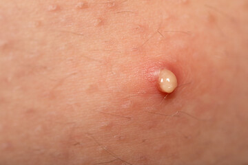 Hormonal disorder - acne on skin