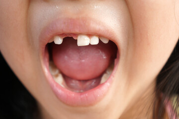 An Asian girl opens her mouth showing a loose milk tooth. broken tooth