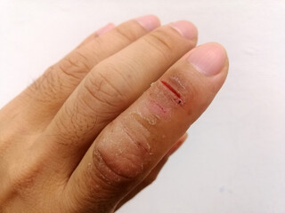 Skin is matt and cracked, the index finger is wound. Finger dermatitis, Skin disease.