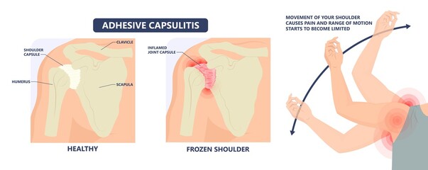 Frozen shoulder adhesive capsulitis surgery stiff crush ribs bone lift athletes arm rupture symptom freezing stiffness rheumatoid arthritis