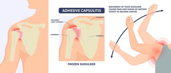 Frozen shoulder adhesive capsulitis surgery stiff crush ribs bone lift athletes arm rupture symptom freezing stiffness rheumatoid arthritis