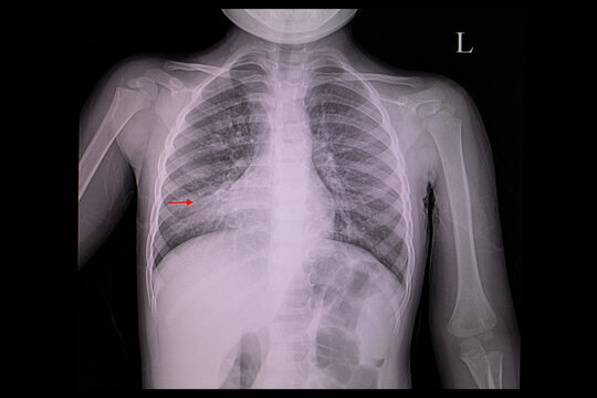 A chest x-ray film of a patient with right lung pneumonia
