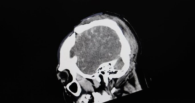 CT cine scan of a patient with falling injury showing severe depression fractures of skull, severe intracerebral hemorrhage, brain edema and herniation.