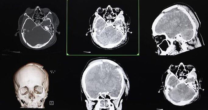 Multi screens CT cine scan of a patient with falling injury showing severe depression fractures of skull, severe intracerebral hemorrhage, brain edema and herniation.