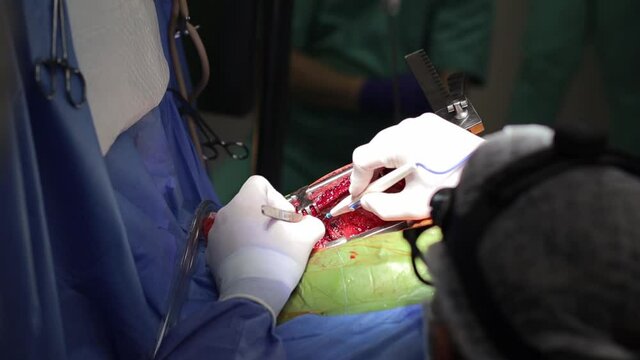 Surgeon doctor operating wearing special lamp lighting using electric cautery heart surgery intervention close-up, open cord surgery minimally invasive surgery