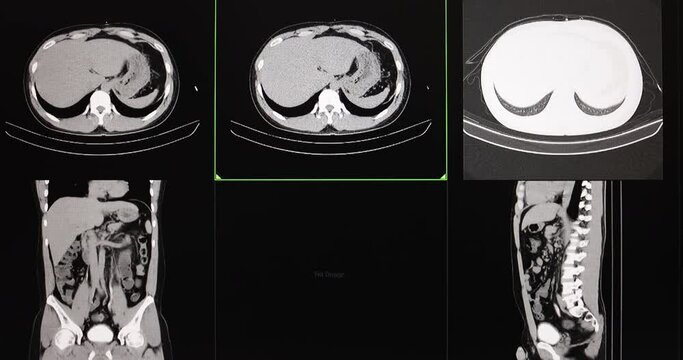 CT cine scan of an abdomen of a patient with two left distal ureteric stones with obstructive uropathy and left hydronephosis and left hydroureter with two left renal calculi.  