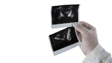  Ultrasound of the male prostate on an isolated white background, the male prostate in the hands of...