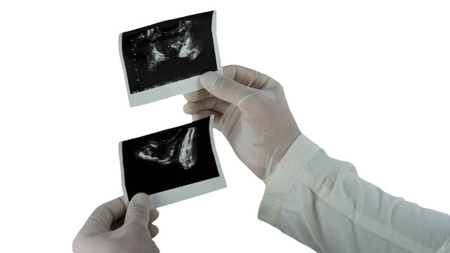 Ultrasound of a male prostate in the hands of a doctor isolated on a white background. Image of the prostate. X-ray of the prostate - Powered by Adobe