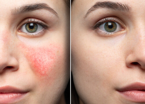 rosacea: before and after the cosmetic treatment of skin disorders