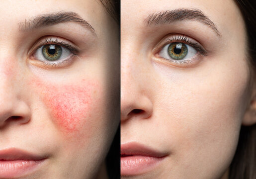 Collage comparing healthy skin and face suffering rosacea, visible blood vessels and capillaries. Caucasian woman face closeup. Medicine and healthcare concept.