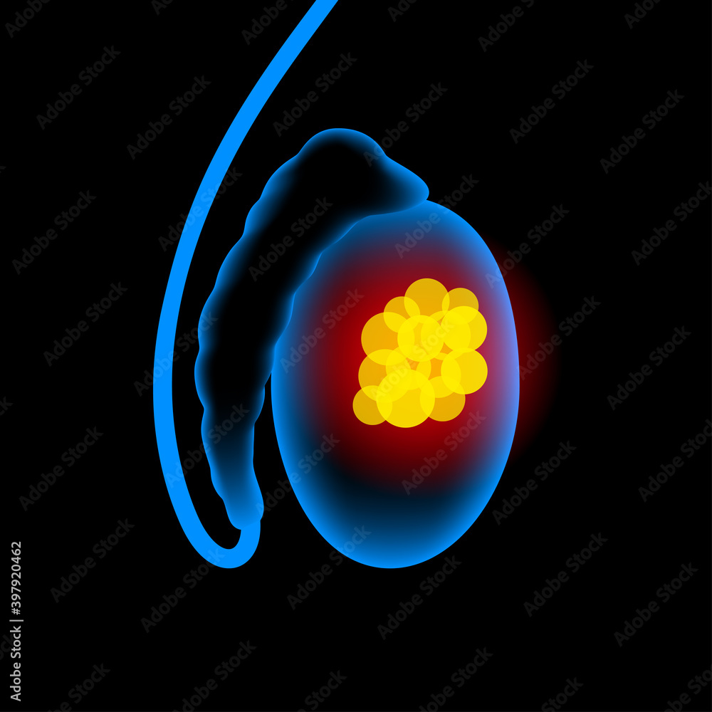 Poster Prostate cancer concept