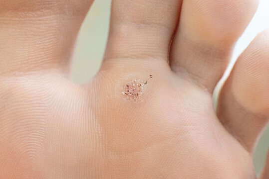 wart on a blunt close-up. Macro shot of human papilloma on the foot.