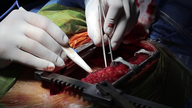 Surgeon doctor operating wearing special lamp lighting using electric cautery heart surgery intervention close-up, open cord surgery minimally invasive surgery