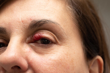  inflammation of the hair bulb on the eyelids, hordeolum, bacterial infection in the eyelid