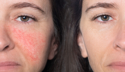 A close-up portrait of before and after a Caucasian woman showing redness and inflamed blood...