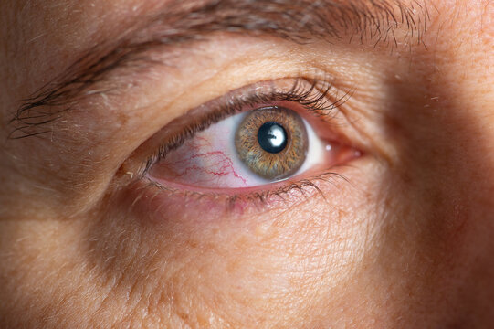 An infected eye's man with conjunctivitis or pink eye
