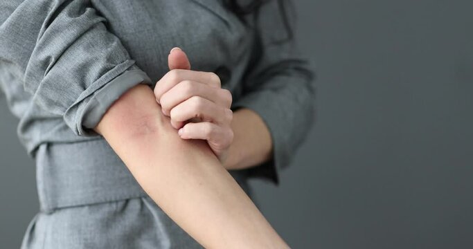 Woman scratching her forearm with her hand 4k movie. Allergic urticaria treatment concept