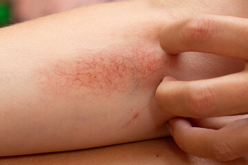 Woman scratching allergic rash dermatitis skin texture