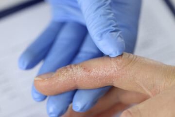 Gloved doctor examines flaky skin of hand.