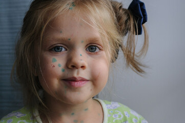 Little girl suffers from chickenpox