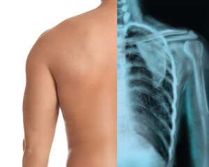 Man, back closeup view, half x-ray photograph. Medical check - obrazy, fototapety, plakaty