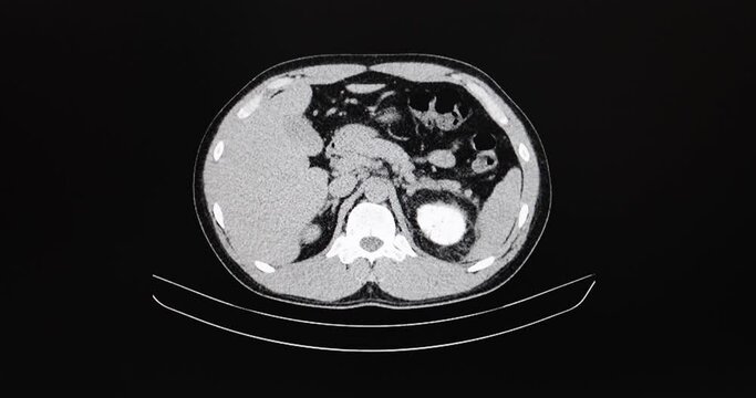 CT cine scan of an abdomen of a patient with two left distal ureteric stones with obstructive uropathy and left hydronephosis and left hydroureter with two left renal calculi