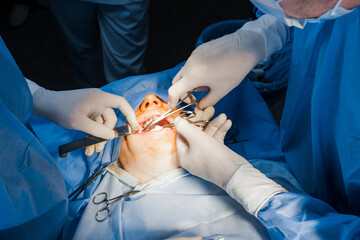 Buccal fat removal. Bisha lumps removal. Plastic surgery in clinic. Plastic surgery operation for...