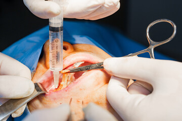 Close-up Buccal fat removal. Bisha lumps removal. Plastic surgery in clinic. Plastic surgery...